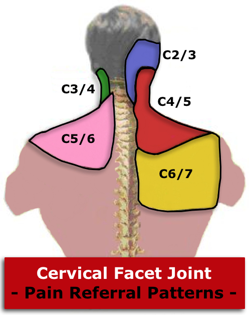 neck facet referral.jpg